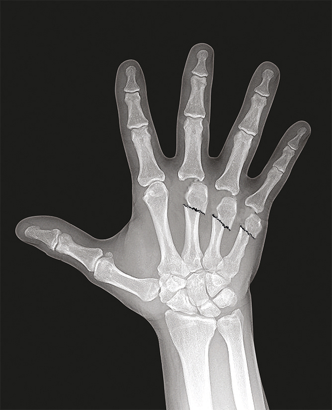 index-long-and-ring-metacarpals-fractures-hand-surgery-source